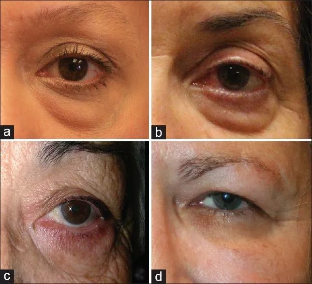 黑眼圈怎么办？如何科学预防黑眼圈？