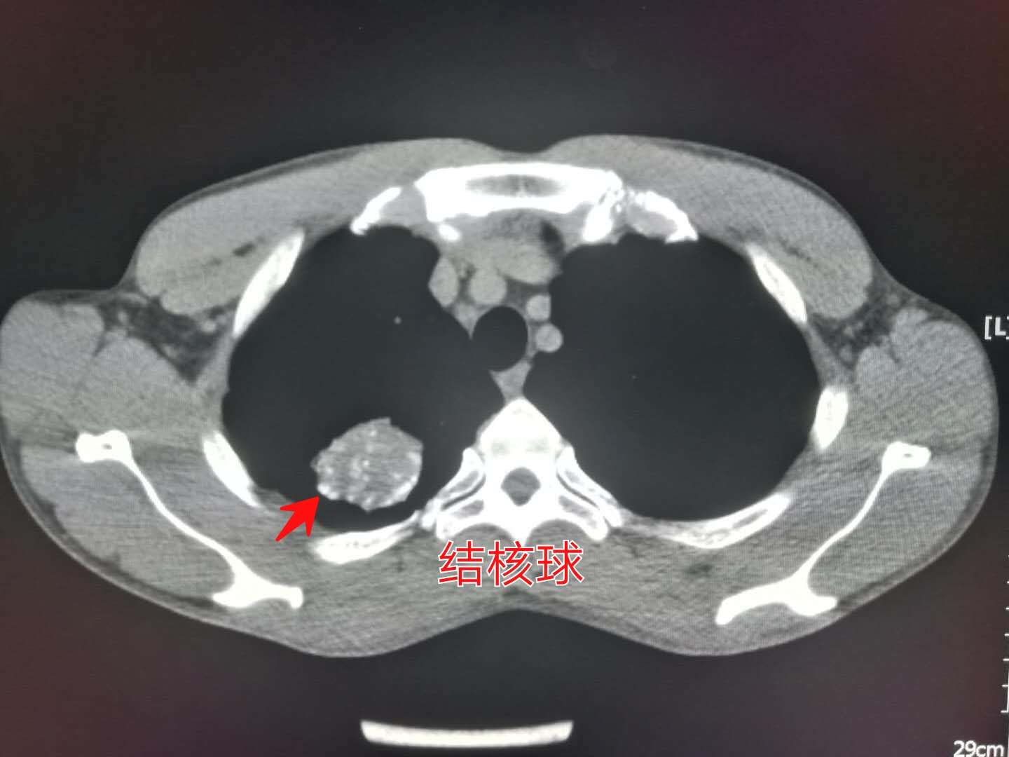 肺结核治疗4个月，这位酷似吴彦祖的帅小伙嘟囔：我想女朋友了！
