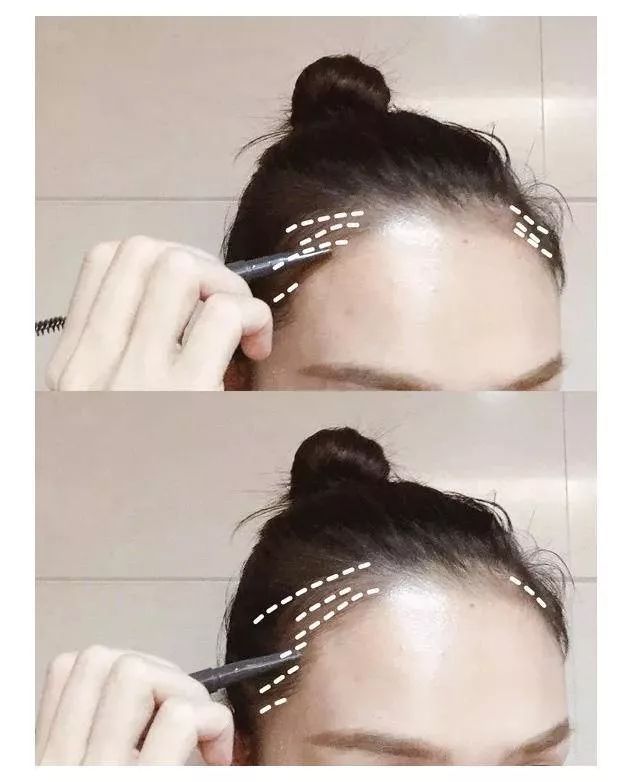 男人发际线后移怎么拯救,如何拯救发际线后移