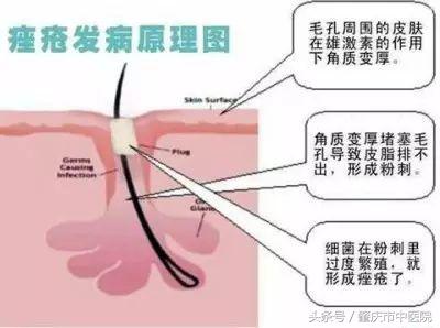「答疑」为什么过了青春期还会长“青春痘”？