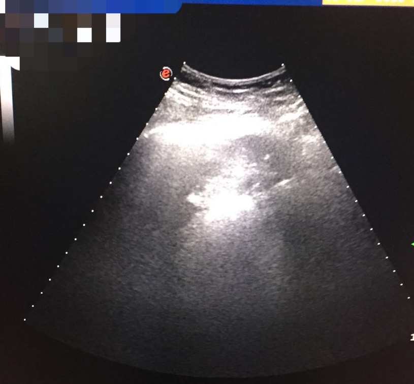 肝癌消融后肝内转移会误诊吗,肝癌肿瘤破裂介入后休克