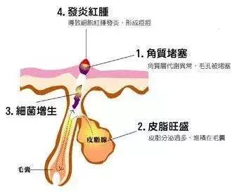 毛孔粗大十大救星,毛孔粗大浮粉原因及解决方法