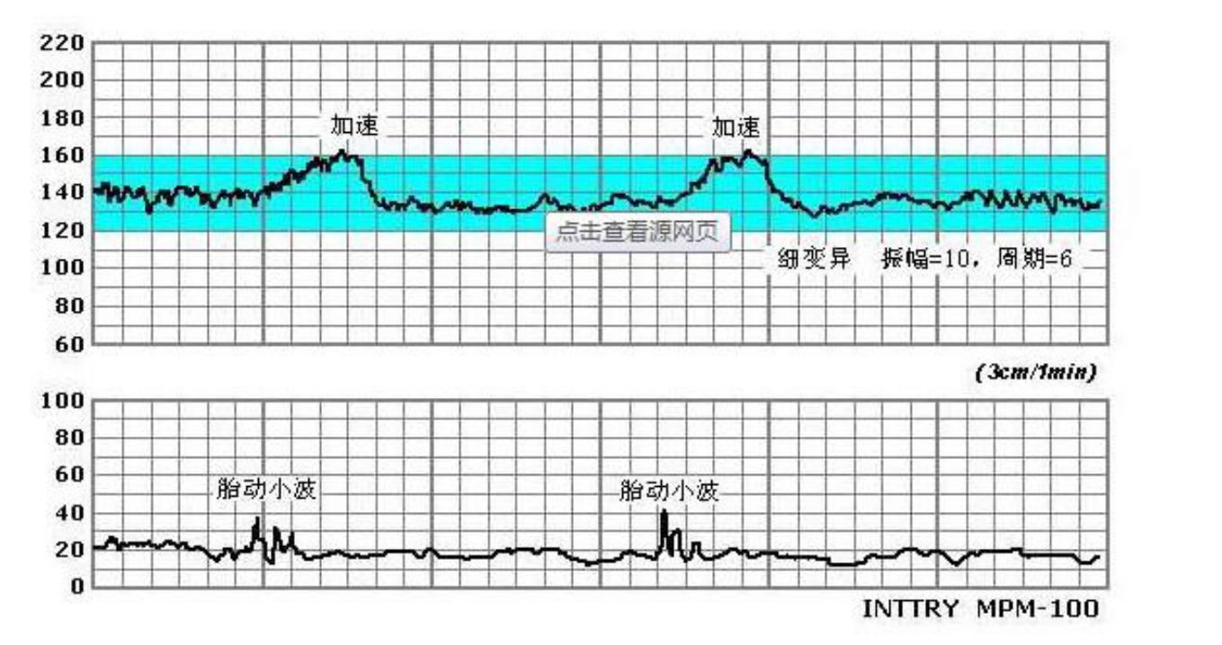 胎心监护有胎心减速是什么原因,胎心监护曲线高低变化大怎么回事