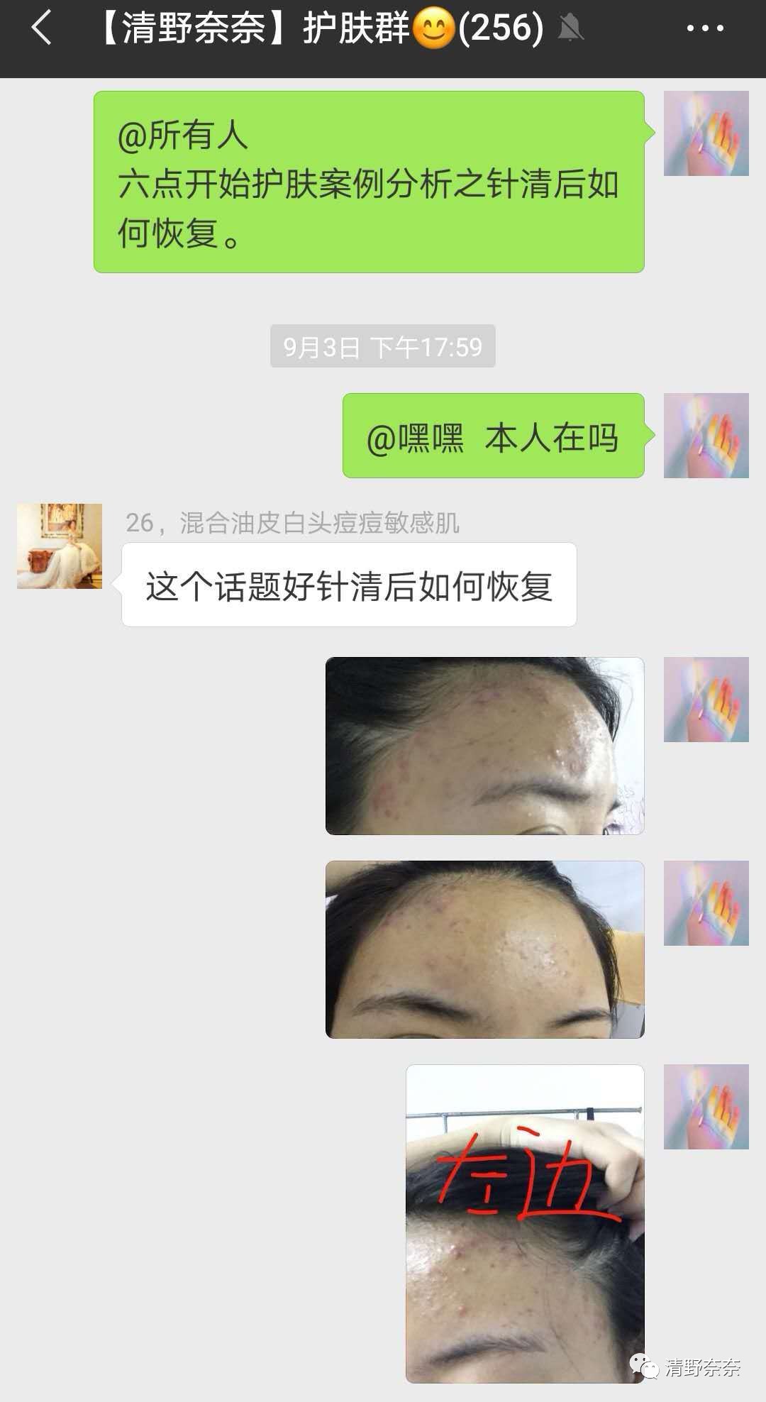 关了美颜也拒做海绵宝宝收毛孔大招vs针清后如何快速摆脱痘印？