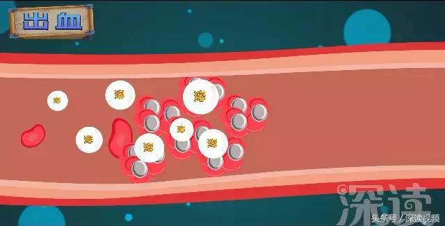 紧急救援脑梗,脑梗溶栓护理科普动画通俗易懂