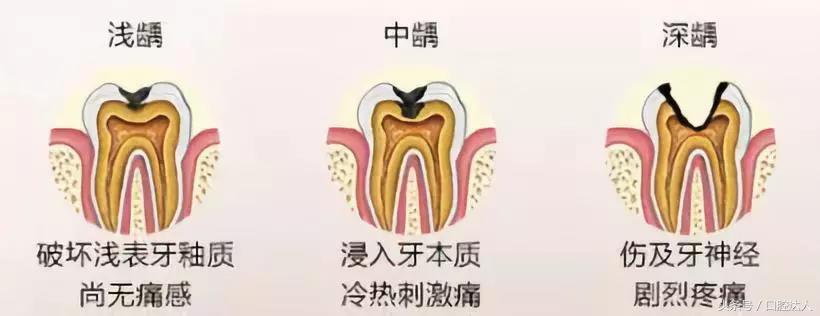 一颗牙怎么自己矫正,一颗牙怎么补那么多次才完成