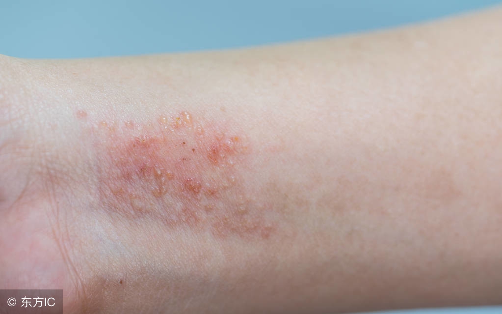不同部位的湿疹怎么治疗,不同类型湿疹表现