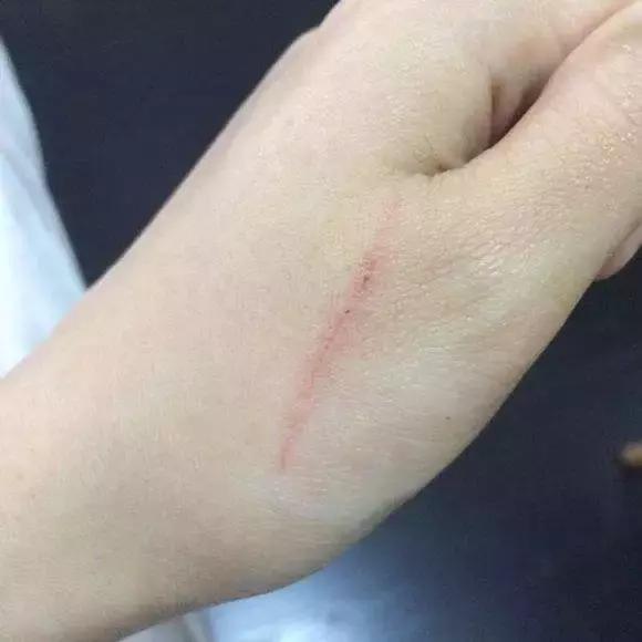 被乳猫爪子划伤要打狂犬疫苗吗,遵义被猫抓伤在哪里打针