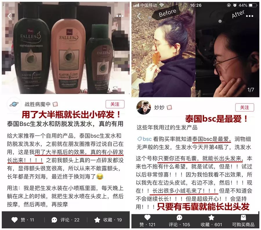 23岁脱发严重m型脱发怎么拯救,脱发斑秃脂溢性脱发