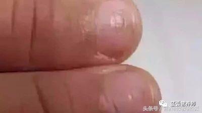 宝宝指甲白斑、凹陷、扁平、分层、脱皮别不在意，有的提示重病！