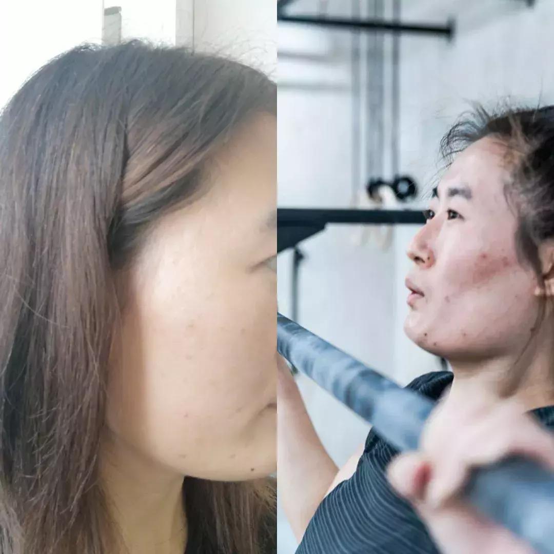 战痘的四个小方法,战痘女孩的秘笈