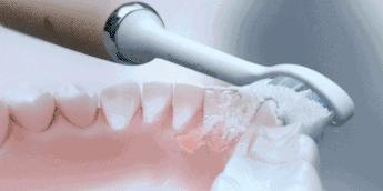 维嘉同款！这个每分钟振动3万次的小东西，让你轻松拥有一口好牙