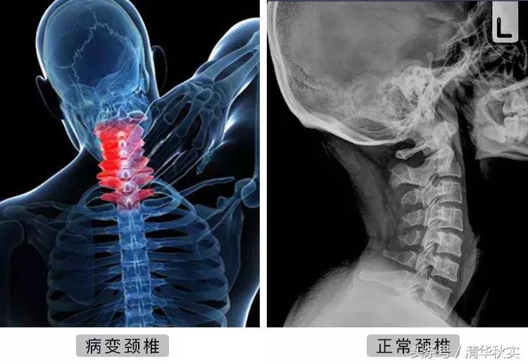 吓尿！每天玩手机4小时，8年后开刀换骨！颈椎病，正疯狂袭来！