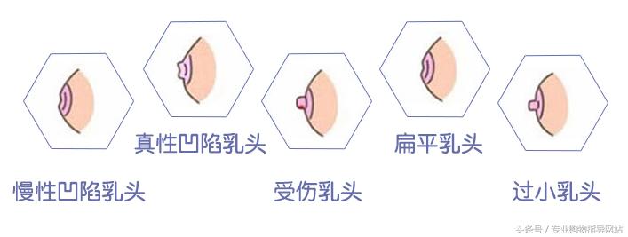 有“乳”无“头”白忙一场这种隐私最好在提前矫正