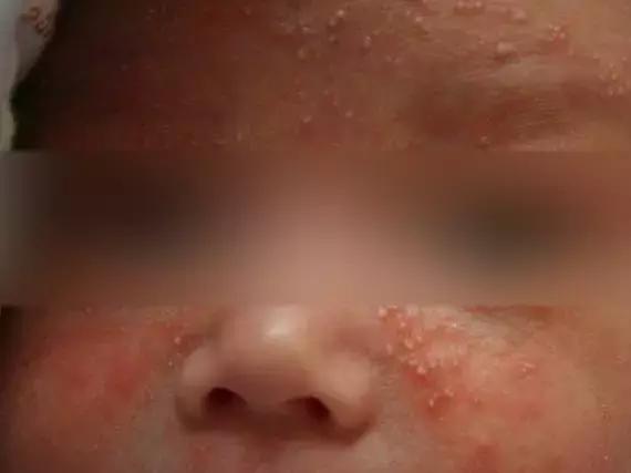 宝宝起红疹子破皮流血怎么办,一岁婴儿身上起红疹小点鉴别