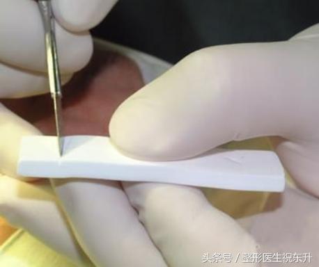 医生不会说的真相,隆鼻后鼻尖一直红是怎么回事