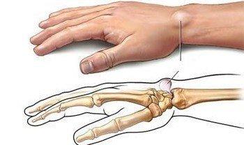 腱鞘囊肿有几种治疗方法,脚背上腱鞘囊肿怎么治疗