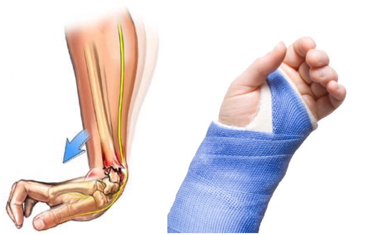 骨折的经历真的很痛苦的说说,骨折的经历