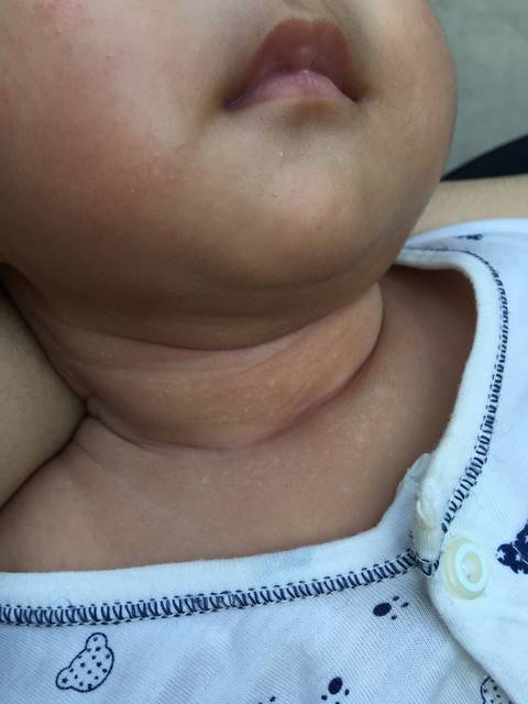 如何让宝宝远离婴儿白斑？你简单的一个动作就可以做得到