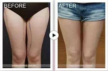 女性双腿空隙很大是什么原因,女性双腿空隙大是什么原因