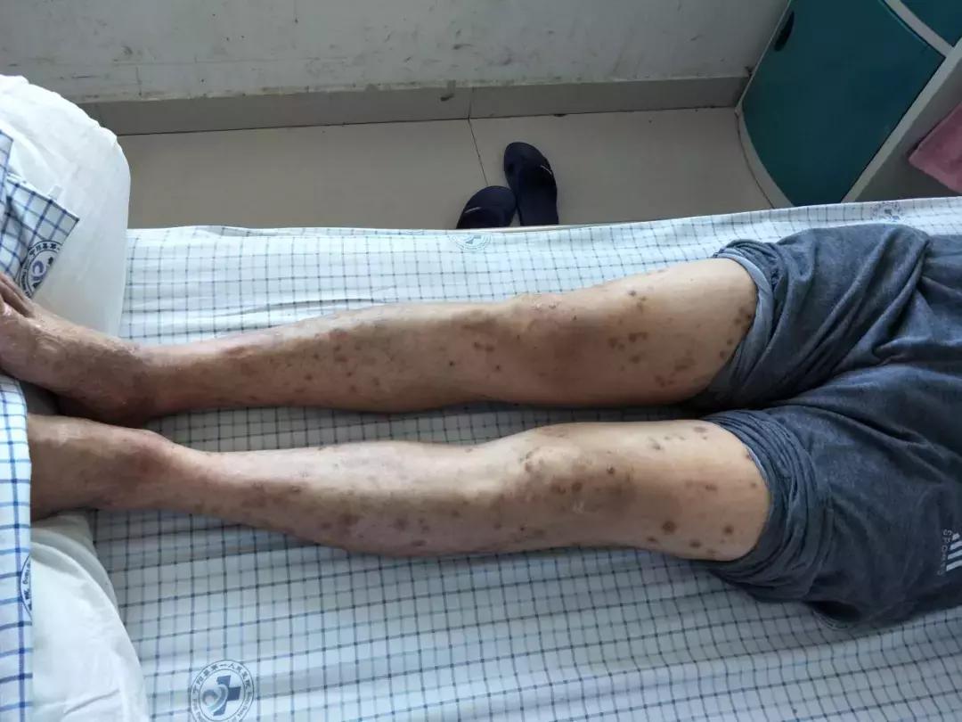 全身起疙瘩溃烂,全身溃烂痒是什么病