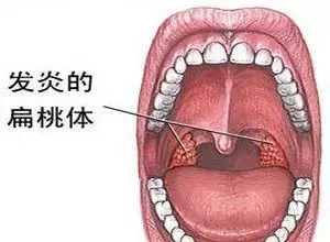 儿童口腔不良习惯的危害和防治,小孩嘴巴臭臭的是消化不良吗