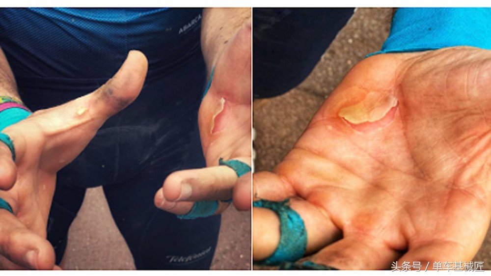 骑行时屁股水泡怎么处理,长距离徒步前脚掌起泡怎么防治