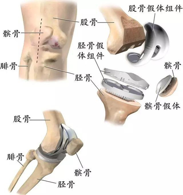 这个病，喜欢运动的人要关注了！医生：不同的损伤治疗方式不同！