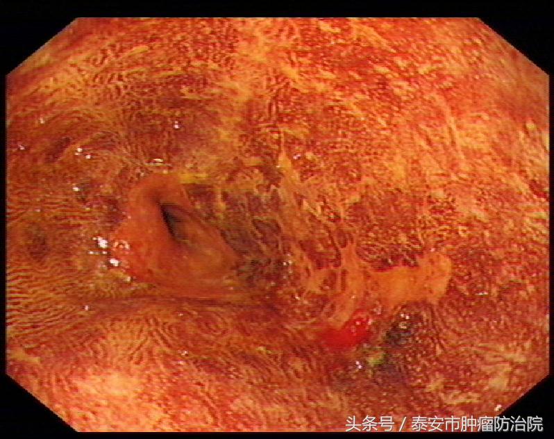 消化道早期癌的内镜下治疗,消化道早癌筛查的方法