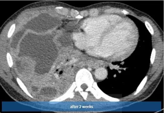 胸壁疼痛的典型特征,临床诊断胸痛是什么意思