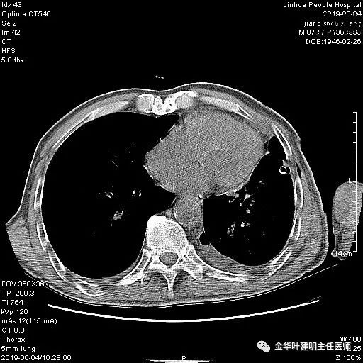 肺手术后乳糜胸是医疗事故吗,肺部切除后乳糜胸治好了