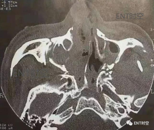 医学影像学解剖鼻骨,医学影像骨折