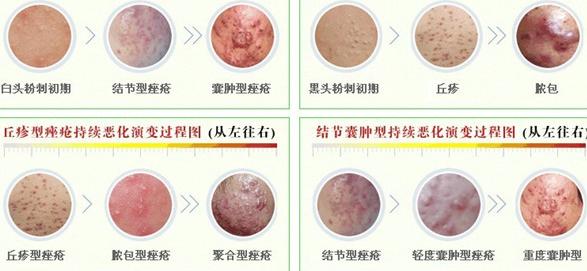 祛痘痘和痘印克星哪个好,痘痘反反复复内调药物