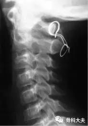 脖子突然往一边歪是怎么回事,孩子脖子突然歪了怎样矫正