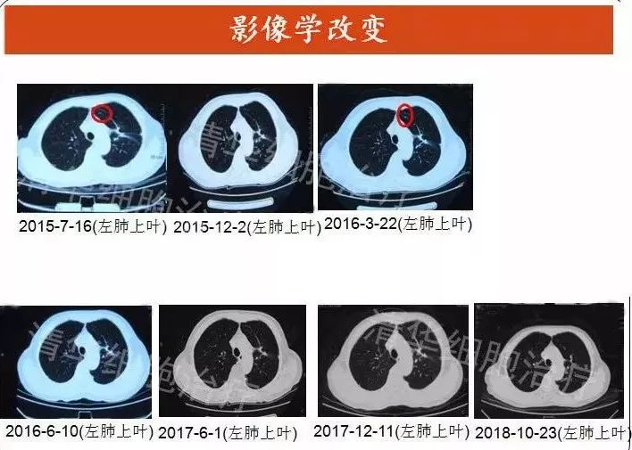 nkt治疗对什么肿瘤有效,nkt治疗适合哪种癌症