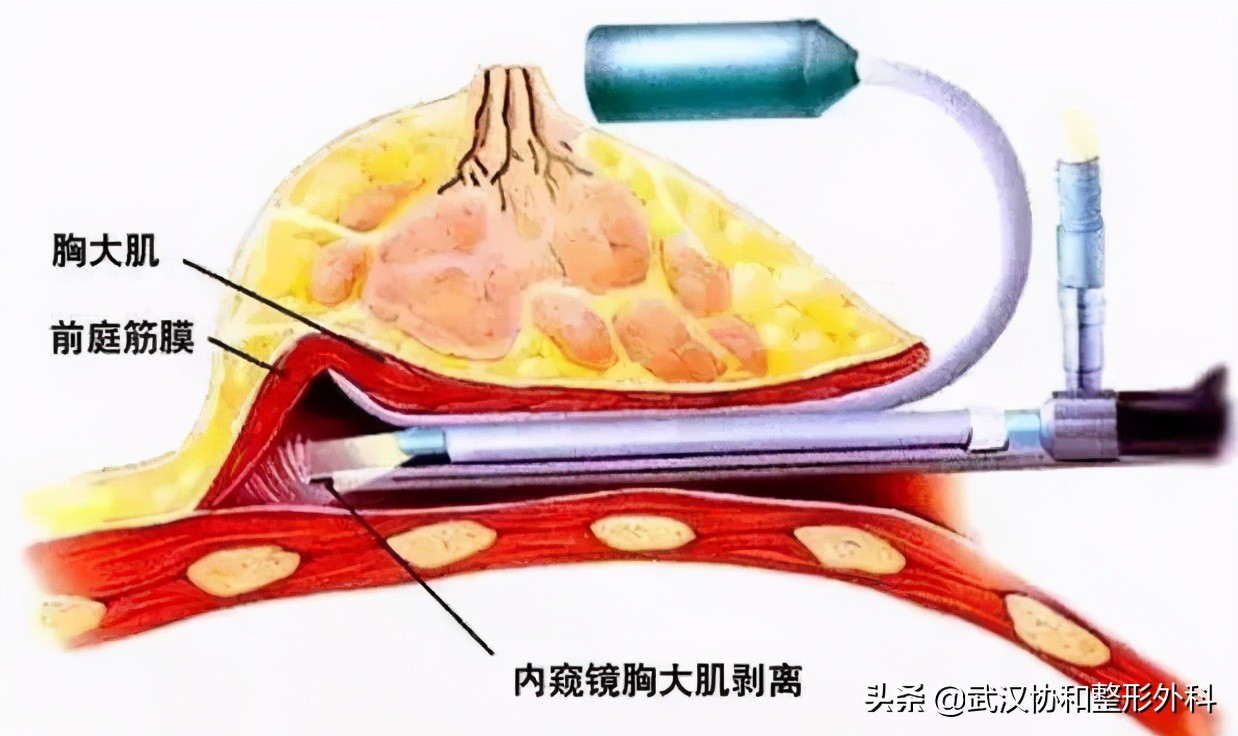 内窥镜隆胸双平面为什么会下垂,最新内窥镜隆胸