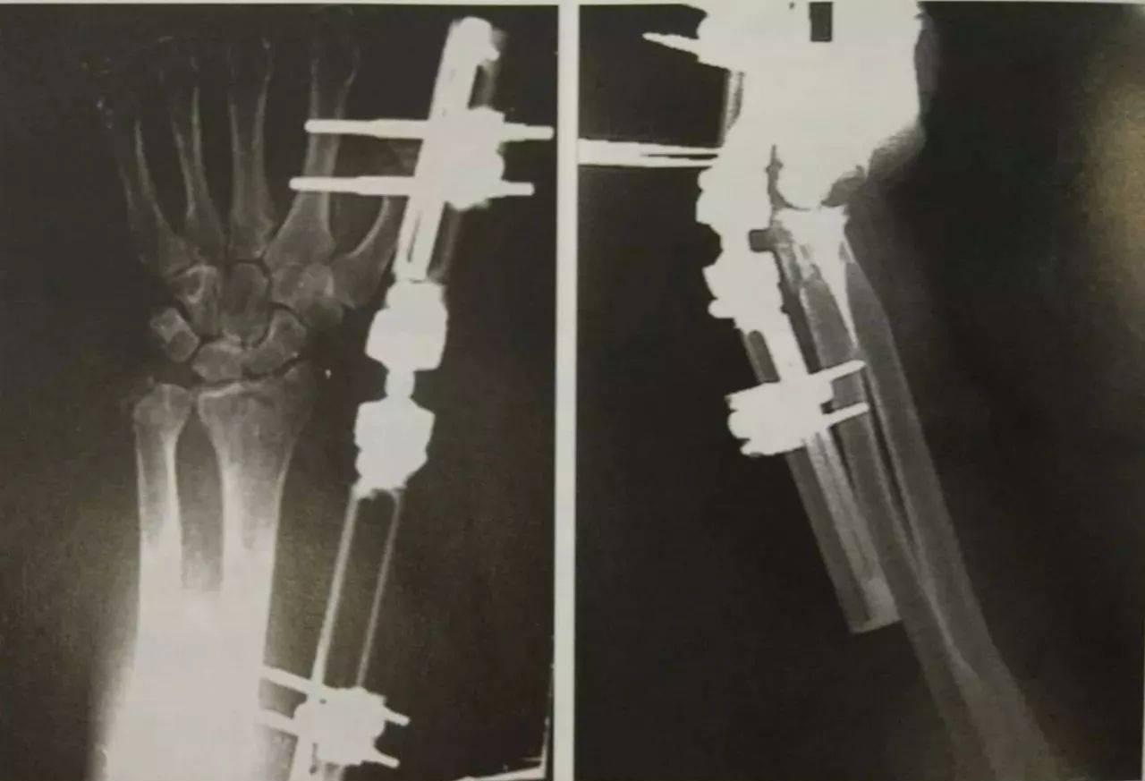 膝关节脱位可以正骨吗,膝关节脱位多长时间做手术最佳