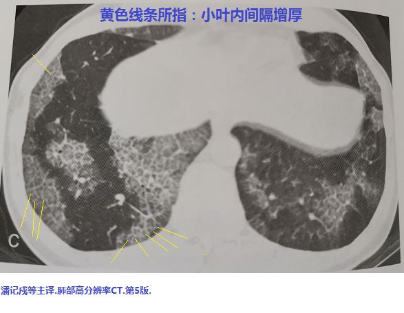 磨玻璃阴影怎么处理,磨玻璃阴影