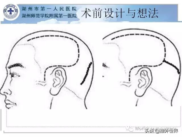 头皮裂伤缝合手术切口分类,头皮切口