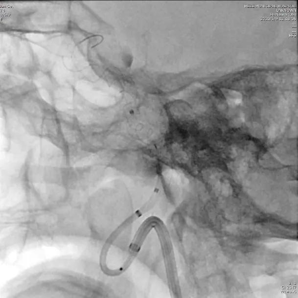 山东治脑动脉瘤最好的专家,菏泽市市立医院血管外科