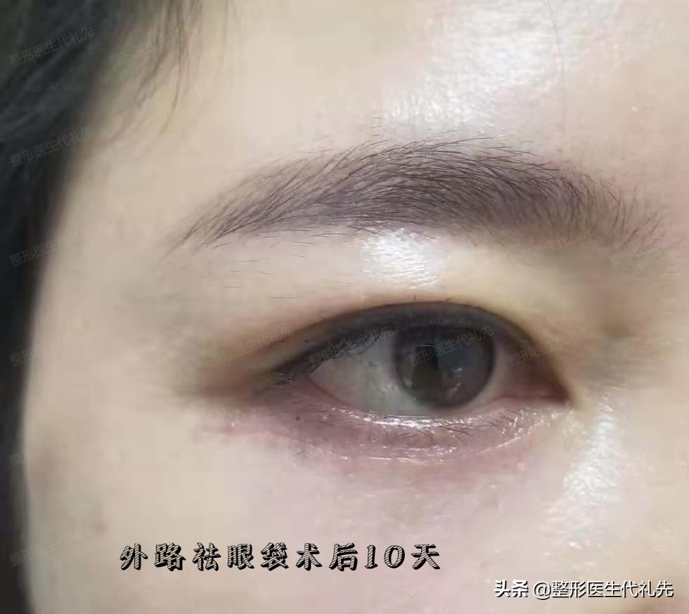 不开刀祛眼袋和开刀祛眼袋哪个好,微创祛眼袋和手术开刀哪种效果好