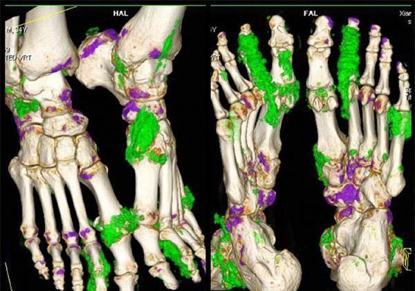 在痛风发作时用什么方法比较好,痛风急性发作期吃什么中药好