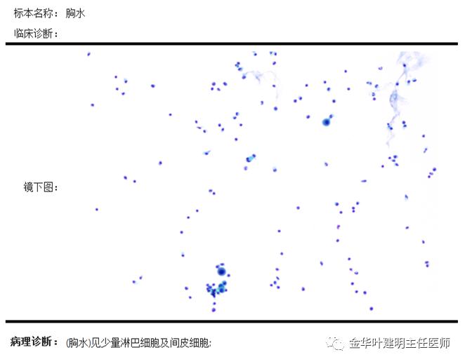 肺癌伴胸腔积液伴膨胀不全,肺癌晚期转移到肝脏引起腹腔积液