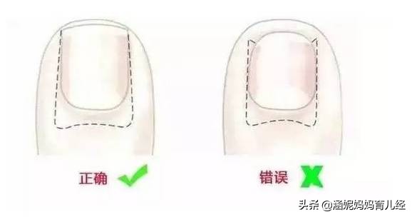 孩子脚趾甲红肿,孩子脚趾头有甲沟炎怎么处理