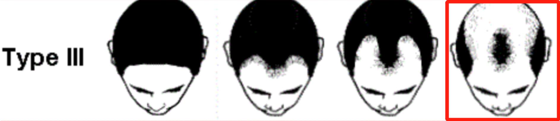 裘德洛的秃头适合什么发型,裘德洛秃顶