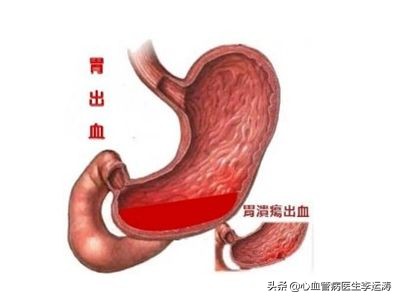 病人血小板低该吃什么药防治心梗,预防心梗复发阿司匹林用量