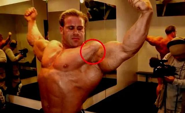 健身过程中长出了生长纹该怎么办,不合理健身导致手臂生长纹怎么办