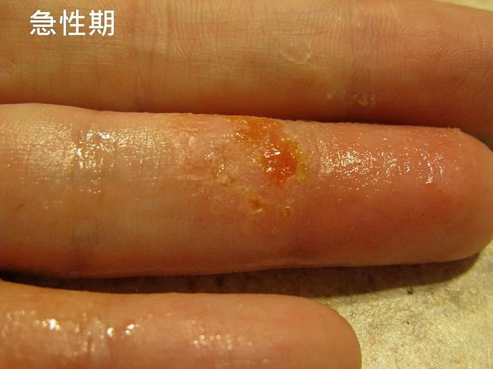 吃巧克力孩子会过敏吗,吃巧克力小孩会增加黑色素吗