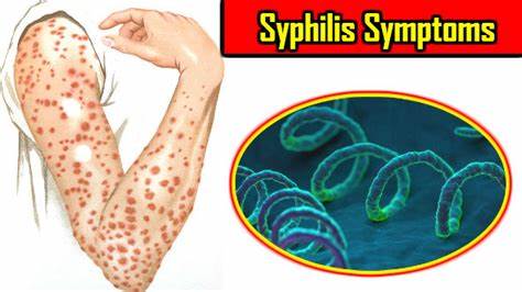 梅毒检查是阳性但是不传染了,梅毒检测阳性会传染吗