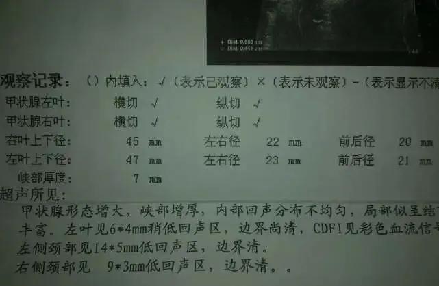 甲状腺彩超结节无包膜是什么意思,甲状腺结节有几个低回声代表什么